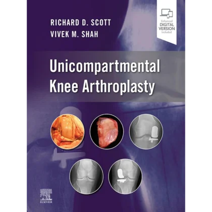 Unicompartmental Knee Arthroplasty