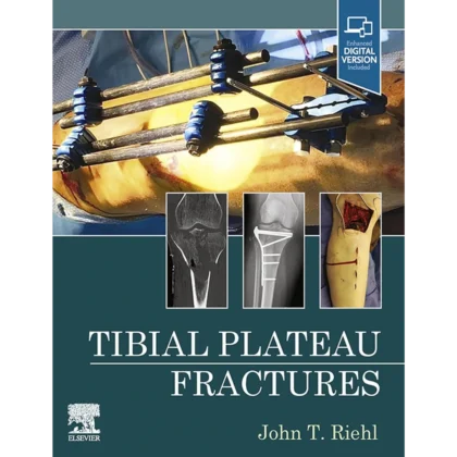 Tibial Plateau Fractures