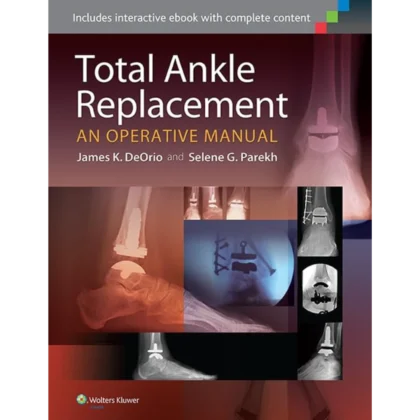 Total Ankle Replacement: An Operative Manual