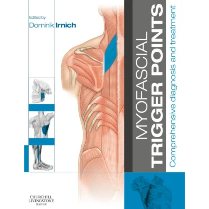 Myofascial Trigger Points